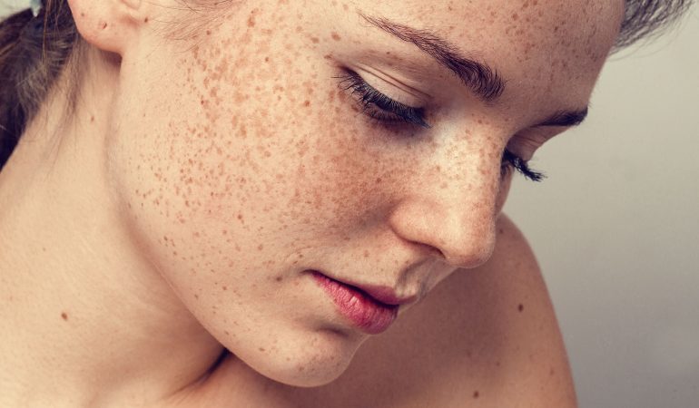 Sommersprossen und Gesichtsflecke. Lassen sich Hautverfärbungen entfernen?